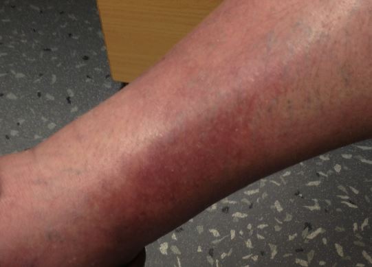 Is It Really Cellulitis Differential Diagnosis Of A Red Leg Aimed